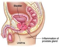Ahonnan a fiatal következményekben a prostatitis - A prosztatitis és uretritis kezelése