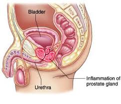 prostatitis 13 éves