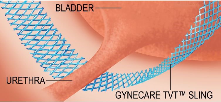 Tension Free Vaginal Tape Tvt Chin Chong Min Urology And Robotic Surgery Centre 9071