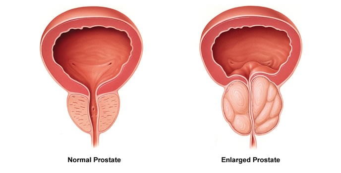 íj a prostatitis ártalmas