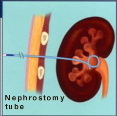 Percutaneous Nephrolithotomy (PCNL) - Chin Chong Min Urology & Robotic ...