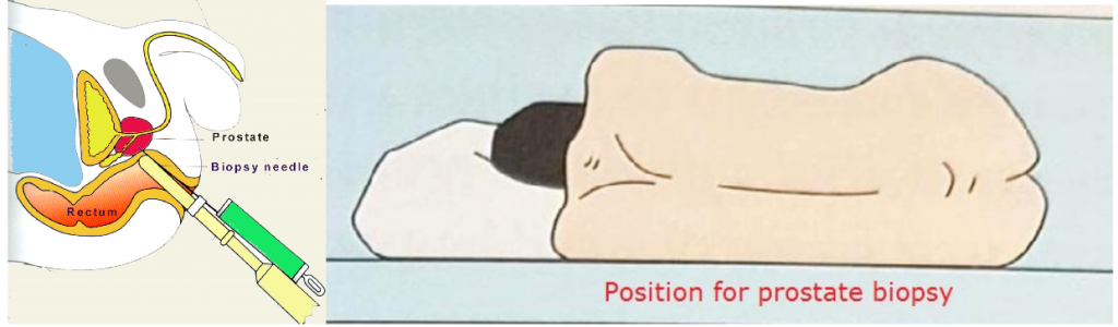 Transrectal Ultrasound Prostate Biopsy 