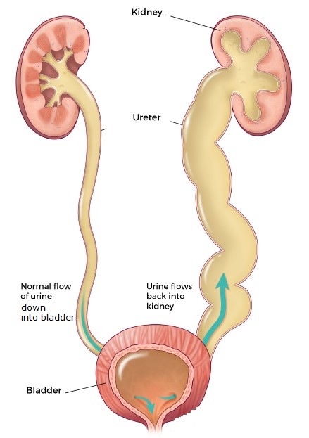 urinary-tract-infection-chin-chong-min-urology-robotic-surgery-centre