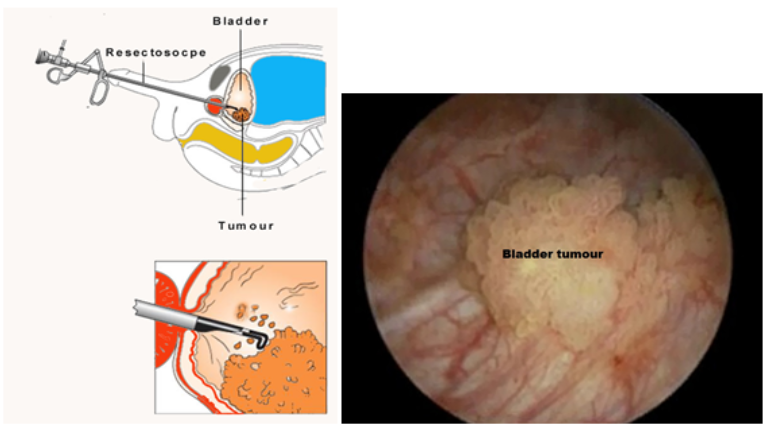 Bladder biopsy Information