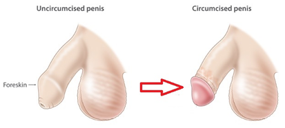 Phimosis, Circumcision