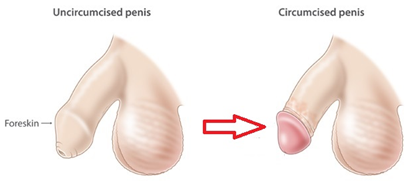 https://ccmurology.com/wp-content/uploads/2020/03/circumcision-remove-excess.png