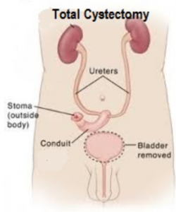 cystectomy-1