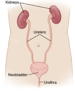 cystectomy-2