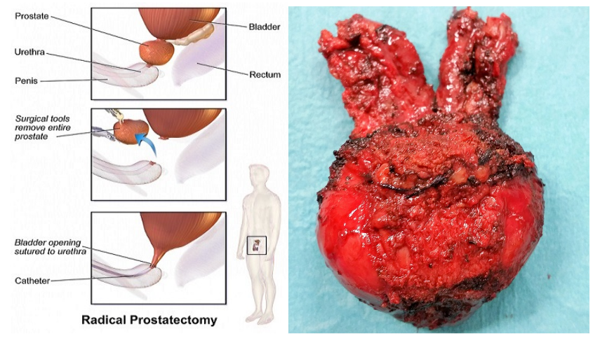 Robotic Prostatectomy - Chin Chong Min Urology & Robotic Surgery Centre