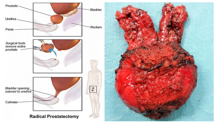 Robotic Prostatectomy Chin Chong Min Urology & Robotic