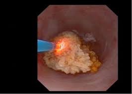 ureteroscopic lithotripsy