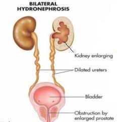 Prostatitis hidronphrosis