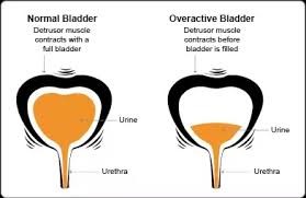 Overactive bladders on sale