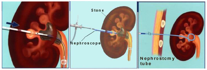 percutaneous lithotripsy