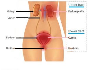 Recurrent Urinary Tract Infection Chin Chong Min Urology