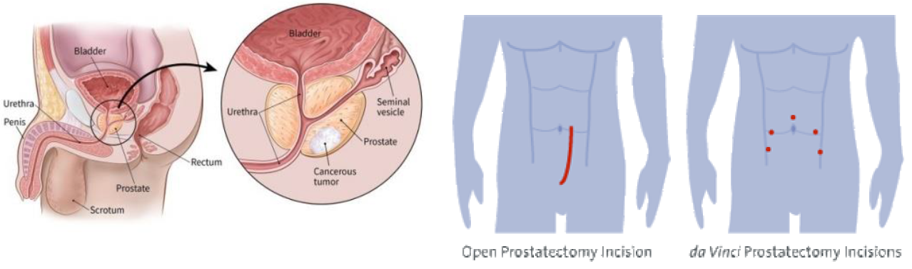 Robotic Prostatectomy Chin Chong Min Urology Robotic Surgery