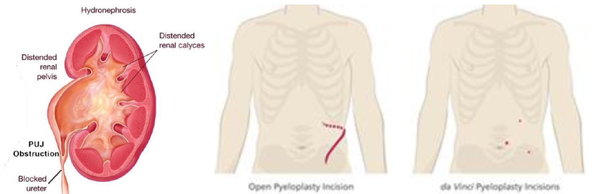 Circumcision  Chin Chong Min Urology & Robotic Surgery Centre