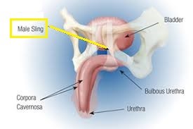 Urinary Incontinence - Chin Chong Min Urology & Robotic Surgery Centre