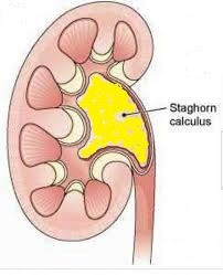 percutaneous lithotripsy