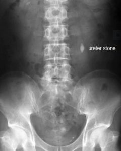 ureterstone