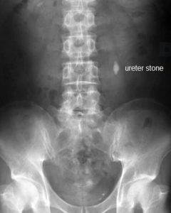 ureteroscopic lithotripsy