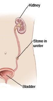 ureteroscopic lithotripsy