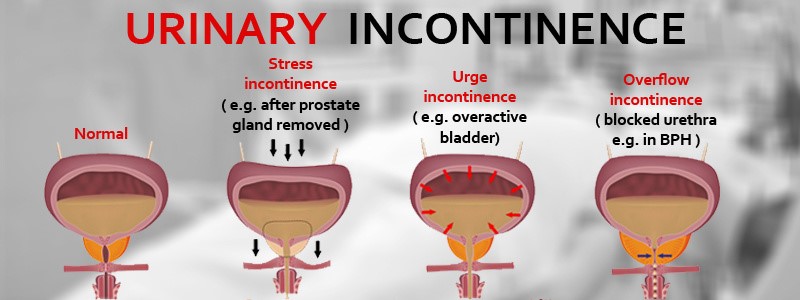 Urinary Incontinence Chin Chong Min Urology And Robotic Surgery Centre