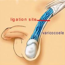 Fig 2. Site for varicocoele ligation. It is best to use the operating microscope to avoid accidental injury to the testicle artery