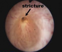 urethrotomy stricture urethral urethroplasty urology catheterisation strictures commonly endoscopic occur