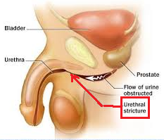 Urethrotomy Urethroplasty Chin Chong Min Urology Robotic