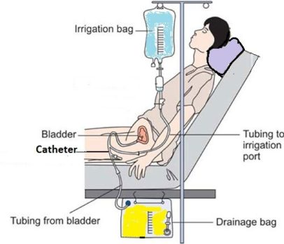 bladder irrigation