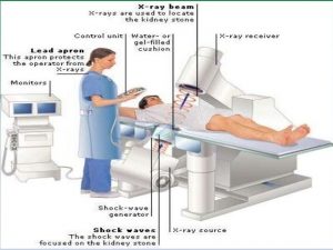 Lithotripsy prostatitis