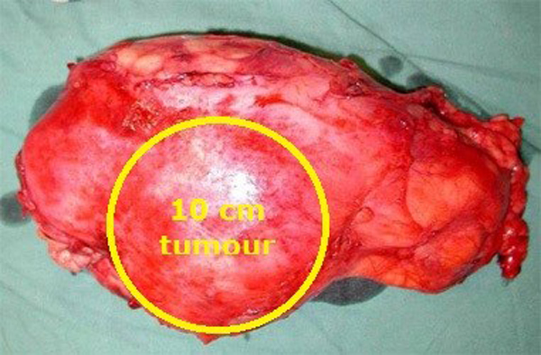 Nephrectomy - Chin Chong Min Urology & Robotic Surgery Centre