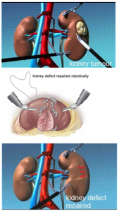 Robotic Partial Nephrectomy - Chin Chong Min Urology & Robotic Surgery ...