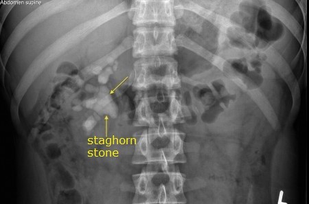 percutaneous lithotripsy