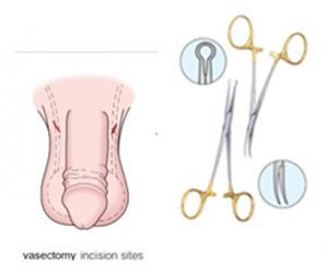 vasectomy stitches