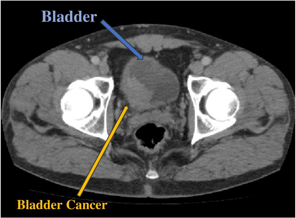 Bladder Cancer | Chin Chong Min Urology & Robotic Surgery Centre