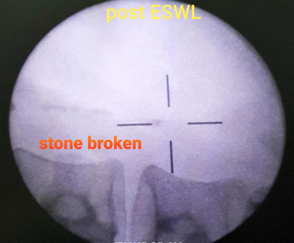 Extracorporeal Shock Wave Lithotripsy ESWL Chin Chong Min Urology