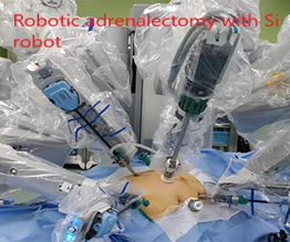 robotic adrenalectomy with si robot