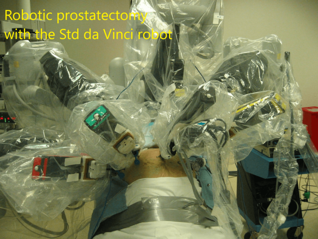 Robotic Prostatectomy Chin Chong Min Urology And Robotic Surgery Centre