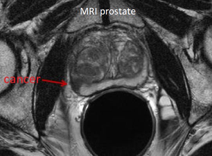 Prostate Cancer - Chin Chong Min Urology & Robotic Surgery Centre