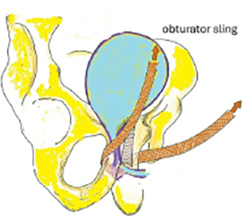 obturator-sling-2 obturator-sling-2